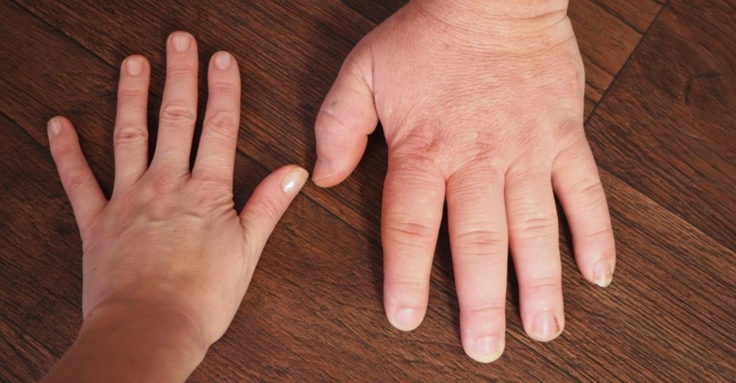 Acromegaly dental problems3